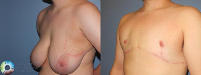 Before & After FTM Top Surgery/Chest Masculinization Case 856 Left Oblique in Denver, CO