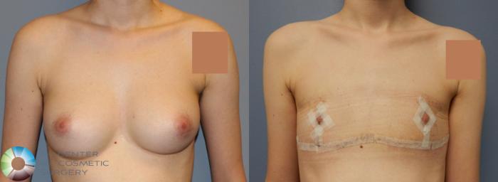 Before & After FTM Top Surgery/Chest Masculinization Case 857 View #1 in Denver and Colorado Springs, CO