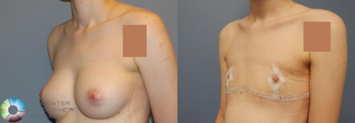 Before & After FTM Top Surgery/Chest Masculinization Case 857 View #2 in Denver and Colorado Springs, CO
