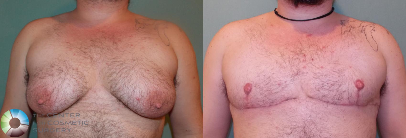 Before & After FTM Top Surgery/Chest Masculinization Case 858 View #1 in Denver and Colorado Springs, CO