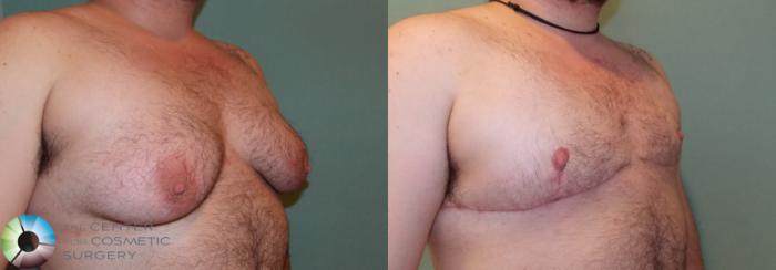 Before & After FTM Top Surgery/Chest Masculinization Case 858 View #2 in Denver and Colorado Springs, CO
