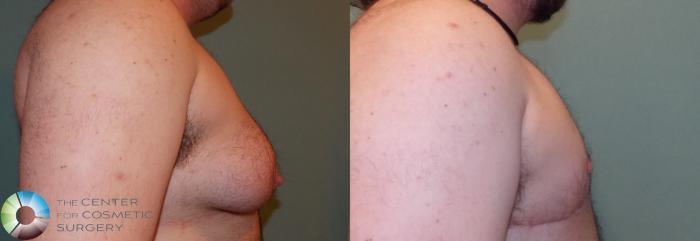 Before & After FTM Top Surgery/Chest Masculinization Case 858 View #3 in Denver and Colorado Springs, CO