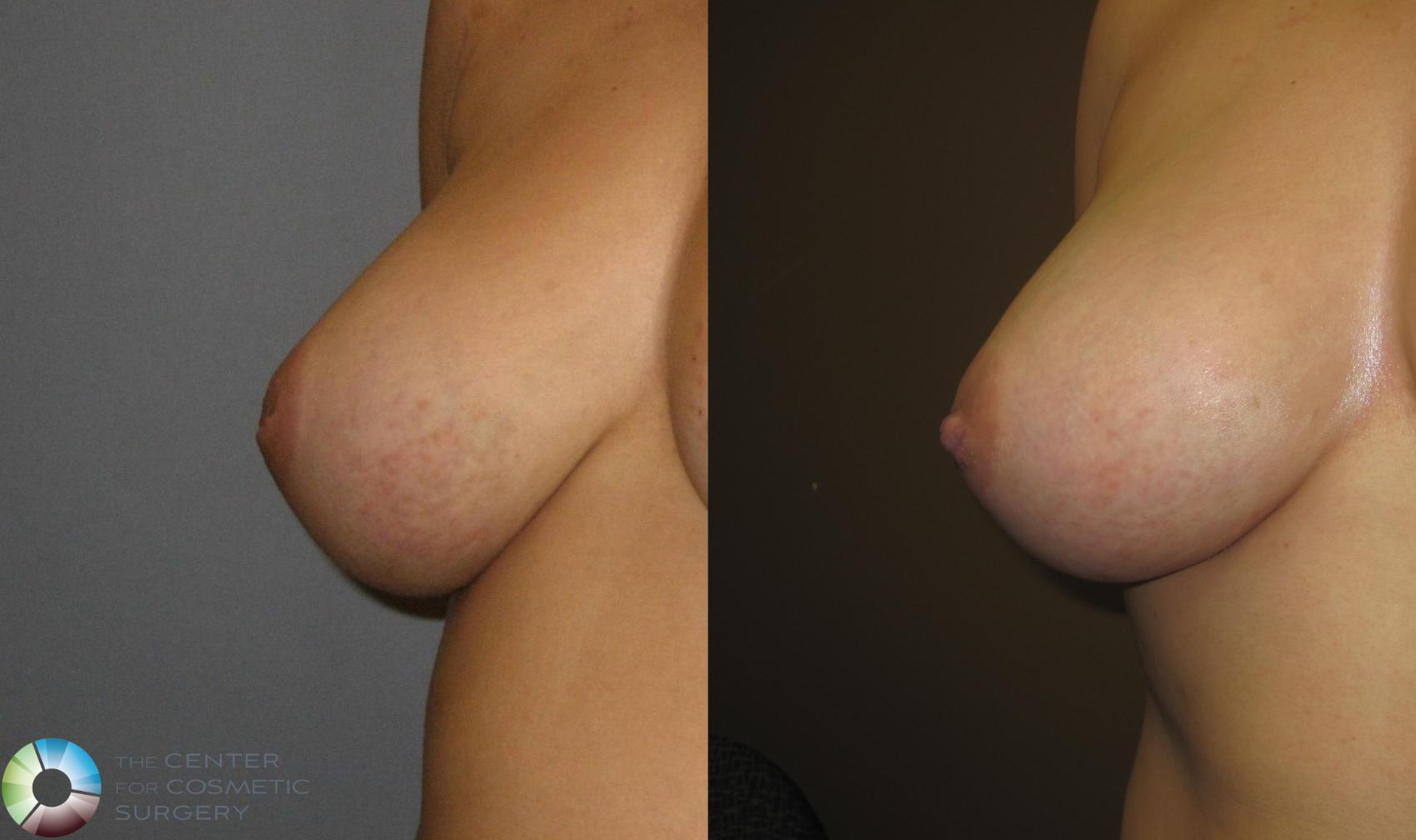 Before & After Inverted Nipple Repair Case 391 View #1 in Denver, CO