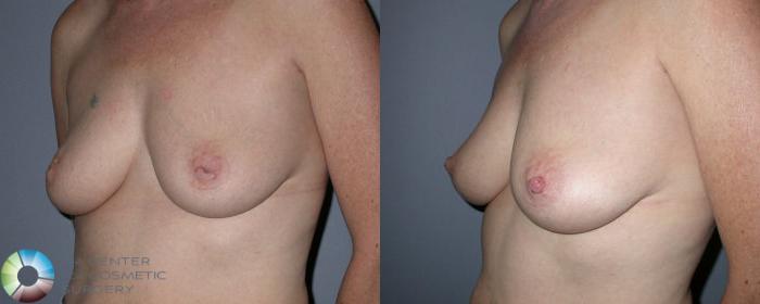 Before & After Inverted Nipple Repair Case 58 View #1 in Denver and Colorado Springs, CO