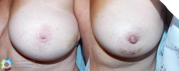 Before & After Inverted Nipple Repair Case 710 View #1 in Denver and Colorado Springs, CO