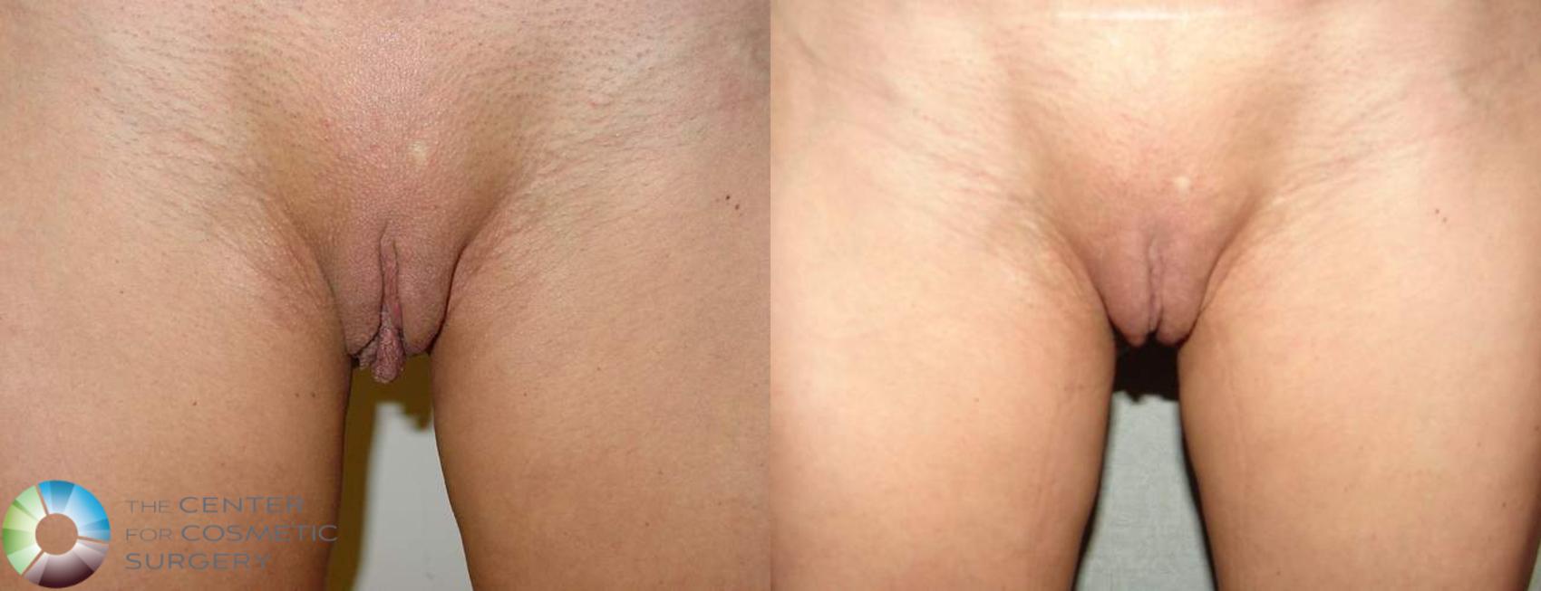 Before & After Labiaplasty Case 558 View #1 in Denver, CO