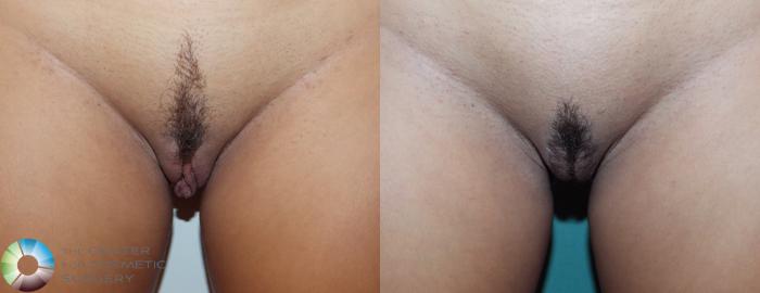 Before & After Labiaplasty Case 739 View #1 in Denver, CO