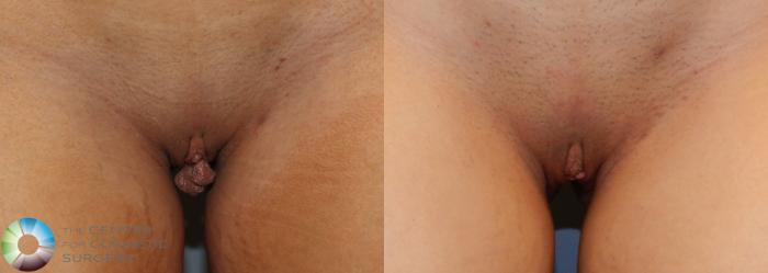 Before & After Labiaplasty Case 814 View #1 in Denver, CO