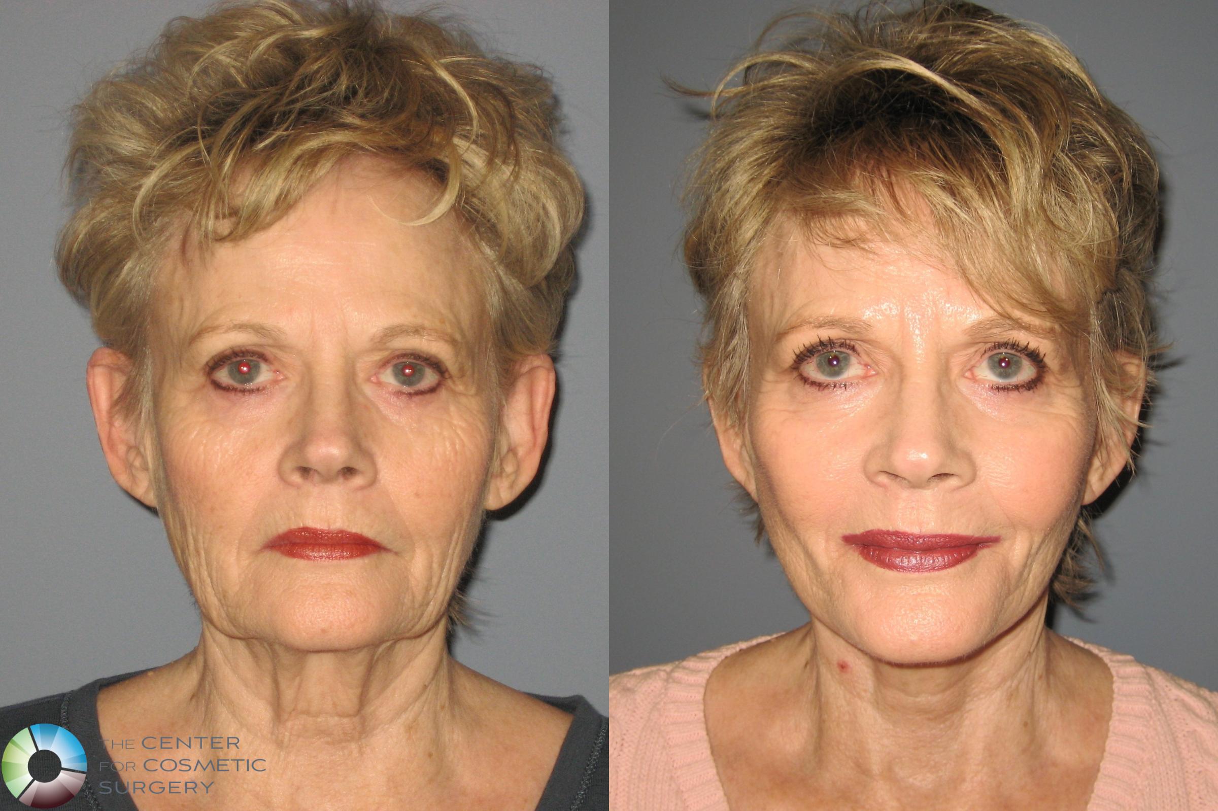 Laser Skin Resurfacing Case 453 Before & After View #1 | Golden, CO | The Center for Cosmetic Surgery
