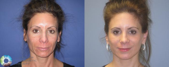 Before & After Laser Skin Resurfacing Case 462 View #1 in Denver and Colorado Springs, CO