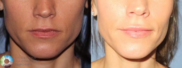 Before & After Lip Augmentation Case 11688 Front in Denver and Colorado Springs, CO