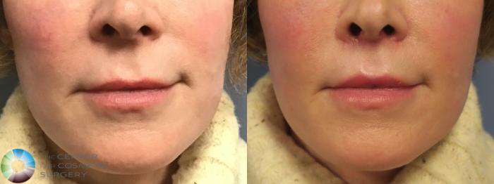Before & After Lip Augmentation Case 11689 Front in Denver and Colorado Springs, CO