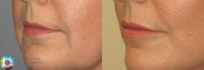 Before & After Lip Augmentation Case 362 View #1 in Denver and Colorado Springs, CO