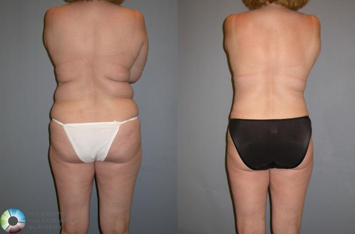 Before & After Liposuction Case 132 View #1 in Denver, CO