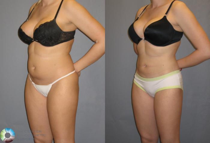 Before & After Power-assisted Liposuction Case 151 View #1 in Denver, CO