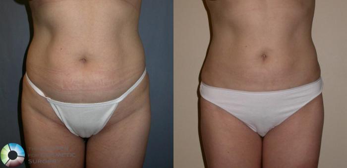Before & After Power-assisted Liposuction Case 30 View #1 in Denver, CO