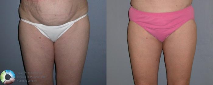 Before & After Liposuction Case 326 View #1 in Denver, CO