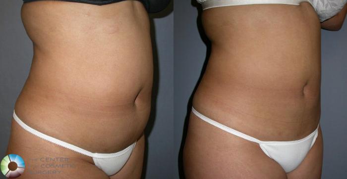 Before & After Liposuction Case 4 View #1 in Denver, CO