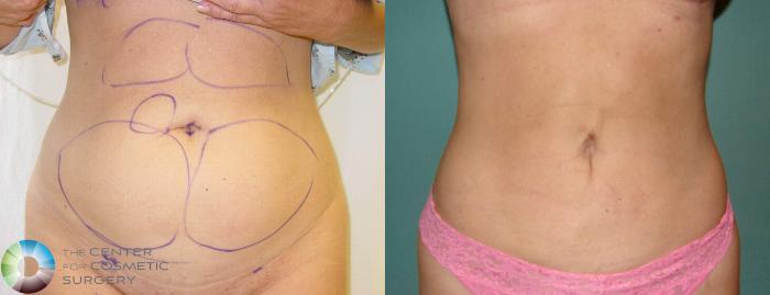 Before & After Liposuction Case 601 View #1 in Denver, CO