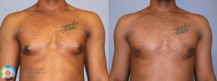 Before & After Male Breast Reduction (Gynecomastia) Case 11666 Front in Denver and Colorado Springs, CO