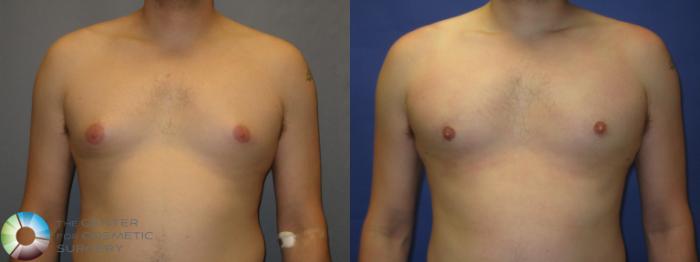Before & After Male Breast Reduction (Gynecomastia) Case 288 View #1 in Denver and Colorado Springs, CO