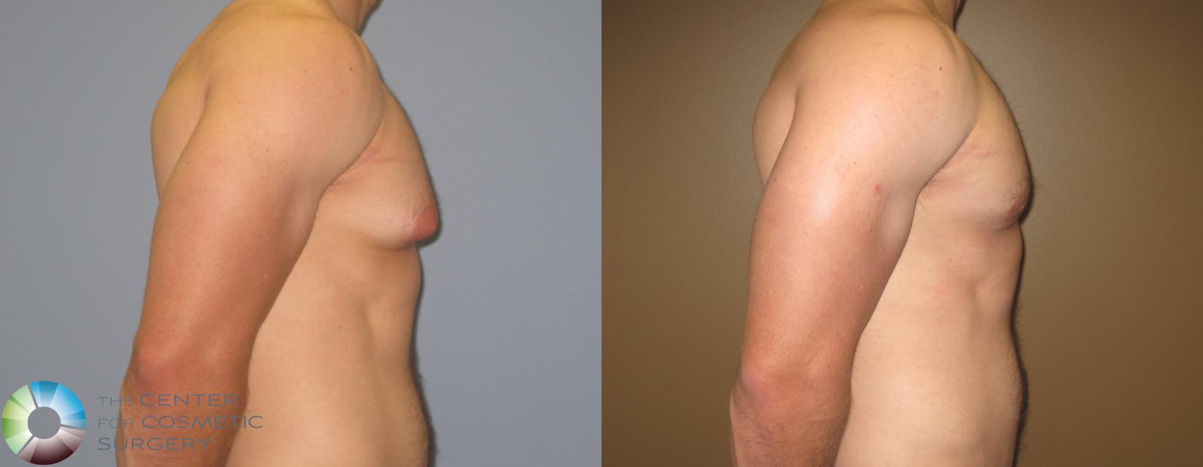 Before & After Male Breast Reduction (Gynecomastia) Case 451 View #1 in Denver and Colorado Springs, CO