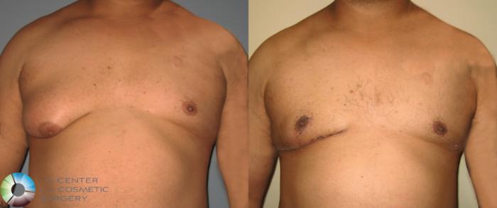Before & After Male Breast Reduction (Gynecomastia) Case 456 View #1 in Denver and Colorado Springs, CO