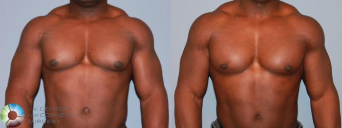 Before & After Male Breast Reduction (Gynecomastia) Case 477 View #1 in Denver and Colorado Springs, CO