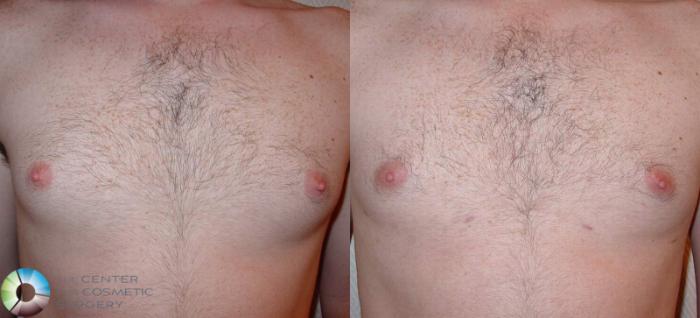 Before & After Male Breast Reduction (Gynecomastia) Case 499 View #1 in Denver and Colorado Springs, CO