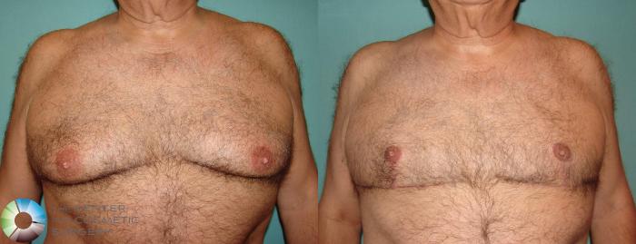 Before & After Male Breast Reduction (Gynecomastia) Case 635 View #1 in Denver and Colorado Springs, CO