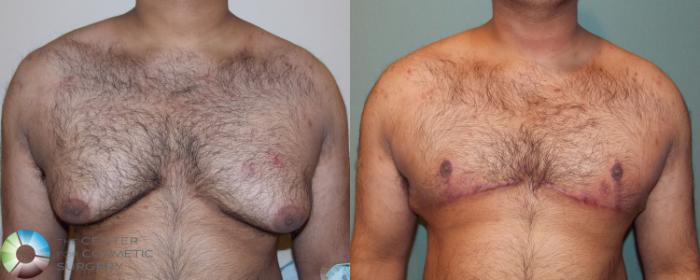 Before & After Male Breast Reduction (Gynecomastia) Case 711 View #1 in Denver and Colorado Springs, CO
