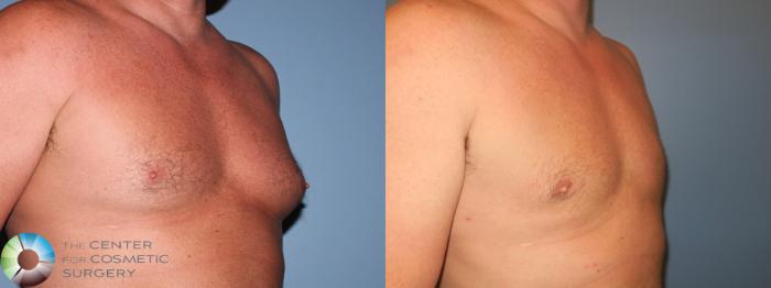 Before & After Male Breast Reduction (Gynecomastia) Case 895 Right Oblique in Denver and Colorado Springs, CO