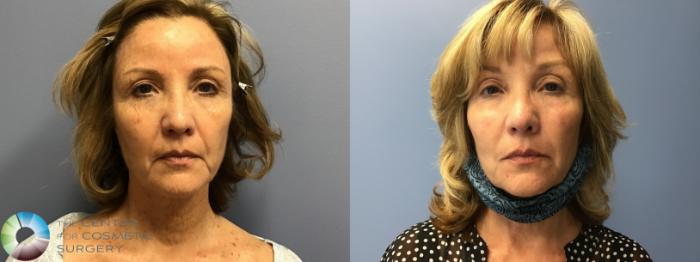 Before & After Microneedling Case 11586 Front in Denver, CO