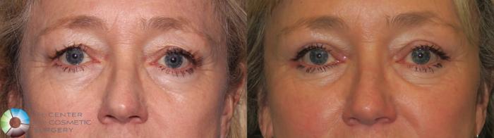 Before & After Mini Brow Lift Case 11458 Close in Denver, CO
