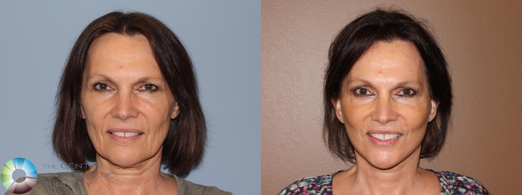 Before & After Mini Brow Lift Case 708 View #1 in Denver and Colorado Springs, CO