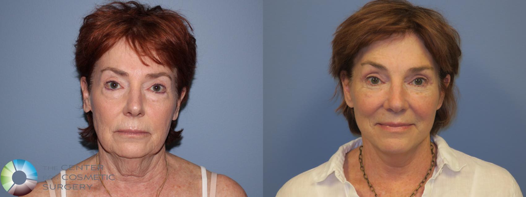 Before & After Mini Facelift Case 11449 Front in Denver and Colorado Springs, CO