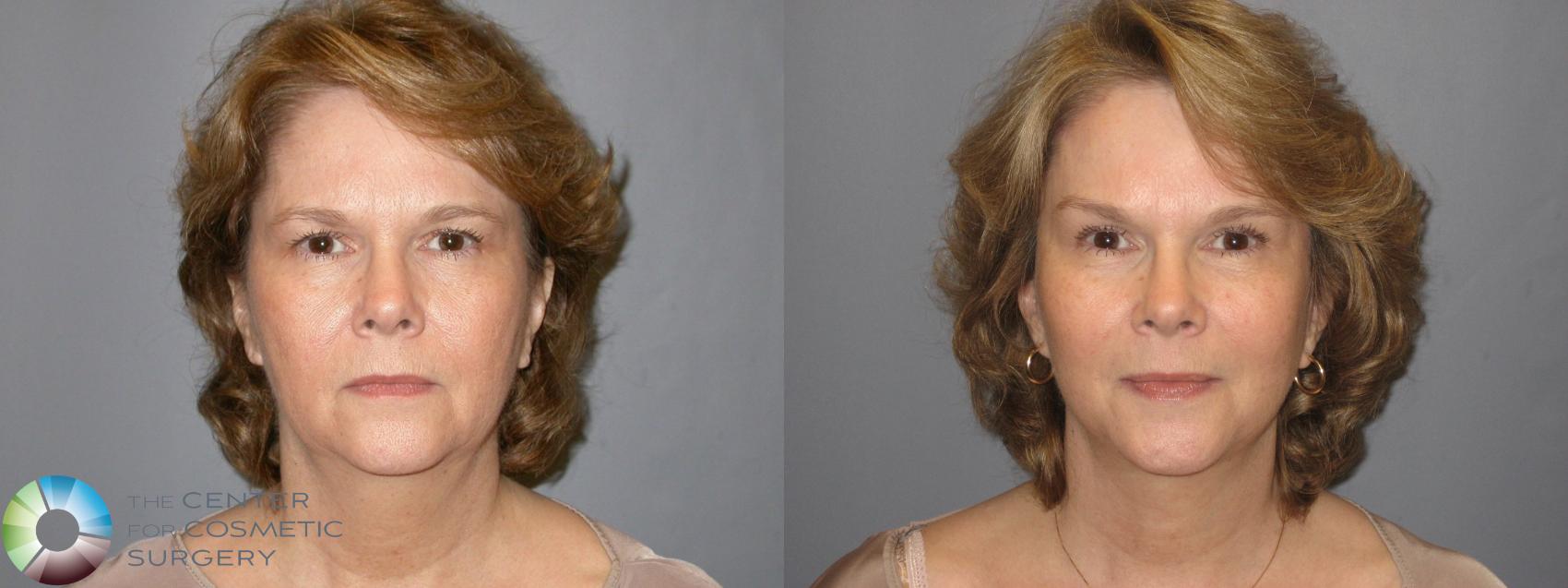 Before & After Mini Facelift Case 116 View #1 in Denver, CO