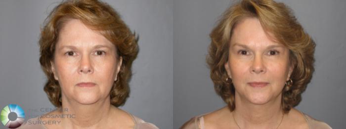 Before & After Eyelid Lift Case 116 View #1 in Denver and Colorado Springs, CO