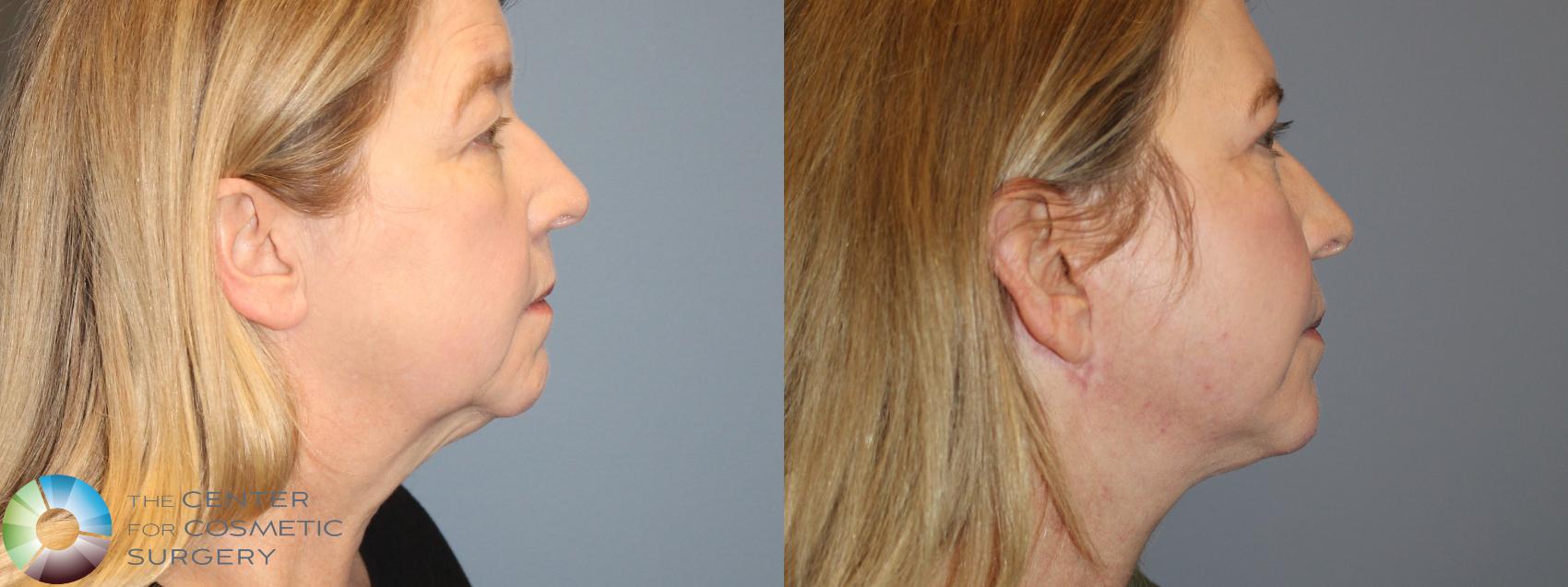 Mini Facelift Before And After Pictures Case Denver And