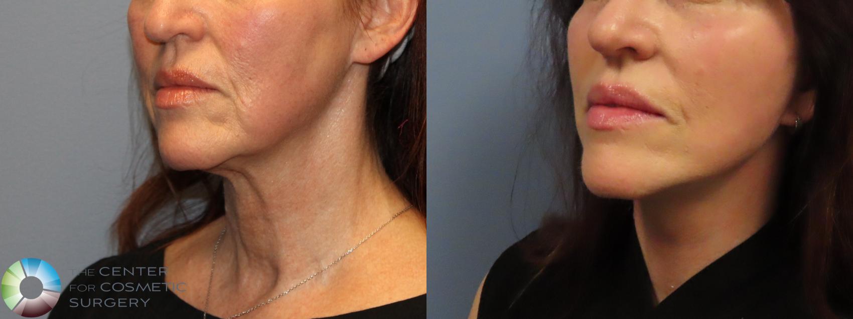 Best Denver Mini-Facelift/Neck Lift