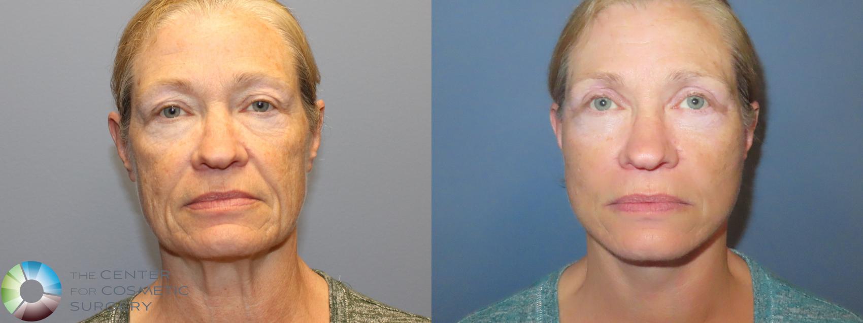 Best Denver Mini-Facelift/Neck Lift