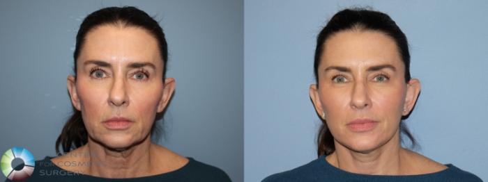 Before & After Neck Lift Case 12168 Front in Denver and Colorado Springs, CO