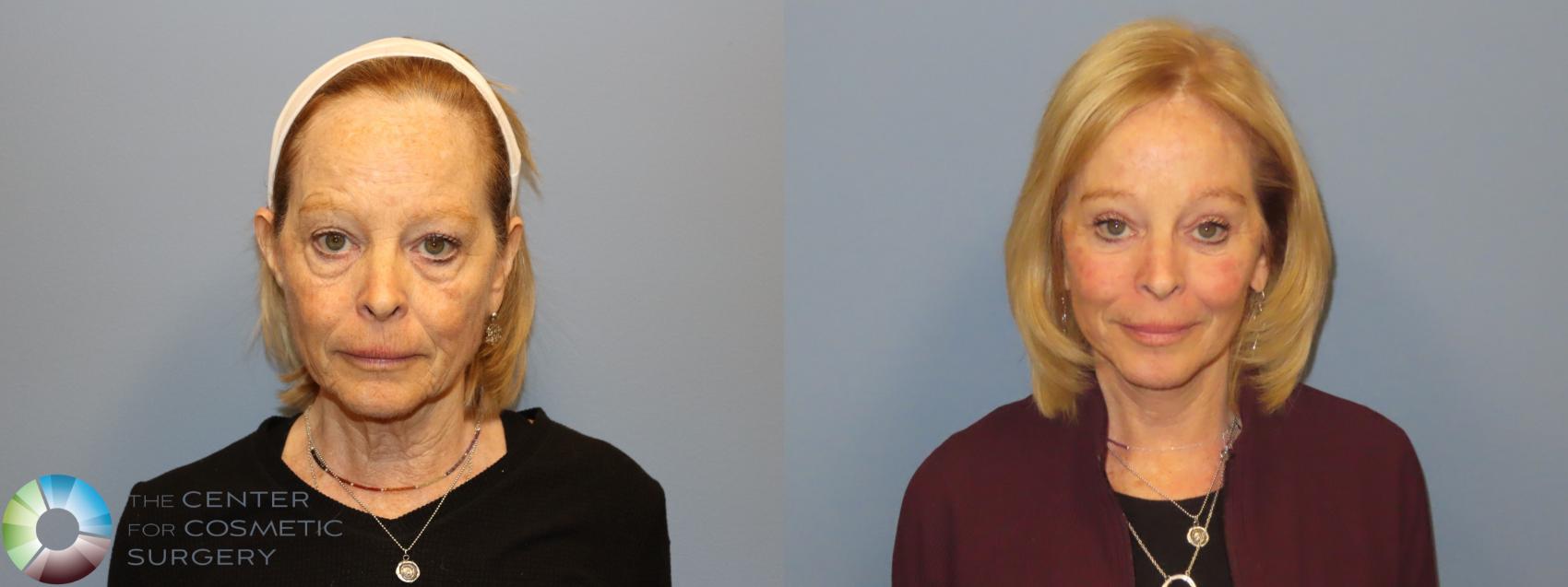 Before & After Mini Facelift Case 12183 Front in Denver and Colorado Springs, CO
