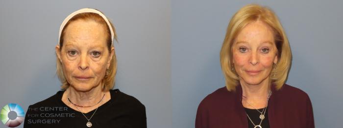 Before & After Mini Facelift Case 12183 Front in Denver and Colorado Springs, CO