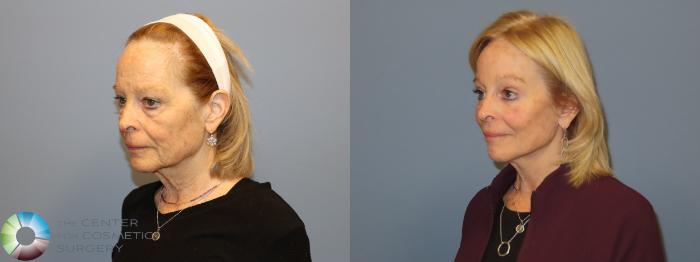 Before & After Mini Facelift Case 12183 Left Oblique in Denver and Colorado Springs, CO