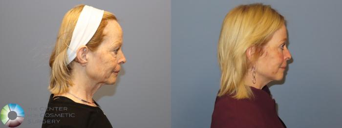 Before & After Mini Facelift Case 12183 Right Side in Denver and Colorado Springs, CO
