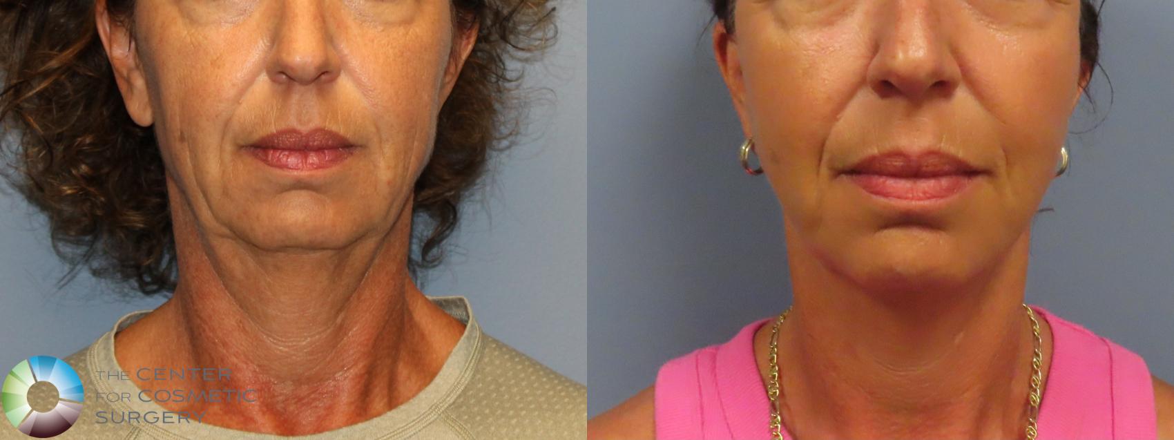 Best Denver Mini-Facelift/Neck Lift