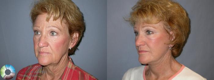 Before & After Eyelid Lift Case 13 View #1 in Denver and Colorado Springs, CO