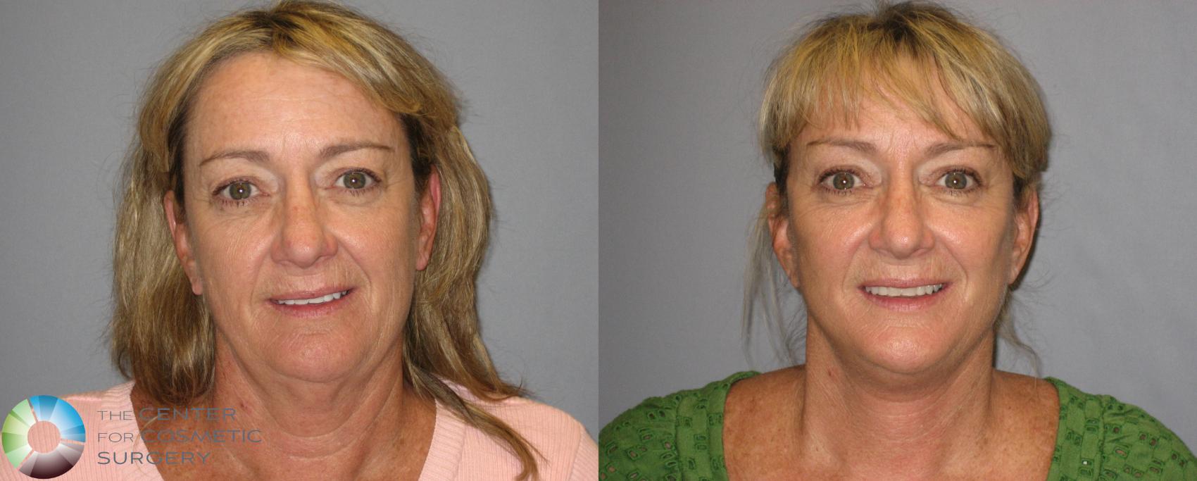 Before & After Mini Facelift Case 243 View #1 in Denver and Colorado Springs, CO