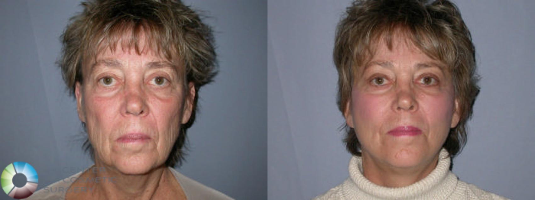 Before & After Mini Facelift Case 26 View #1 in Denver, CO